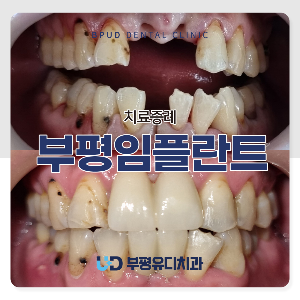 부평임플란트
