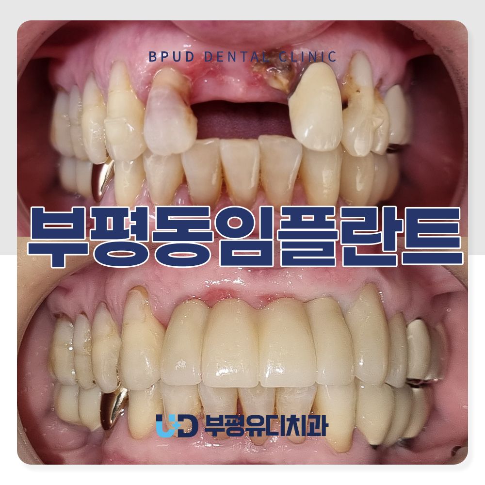 부평동임플란트