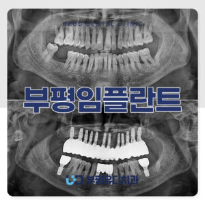 부평임플란트