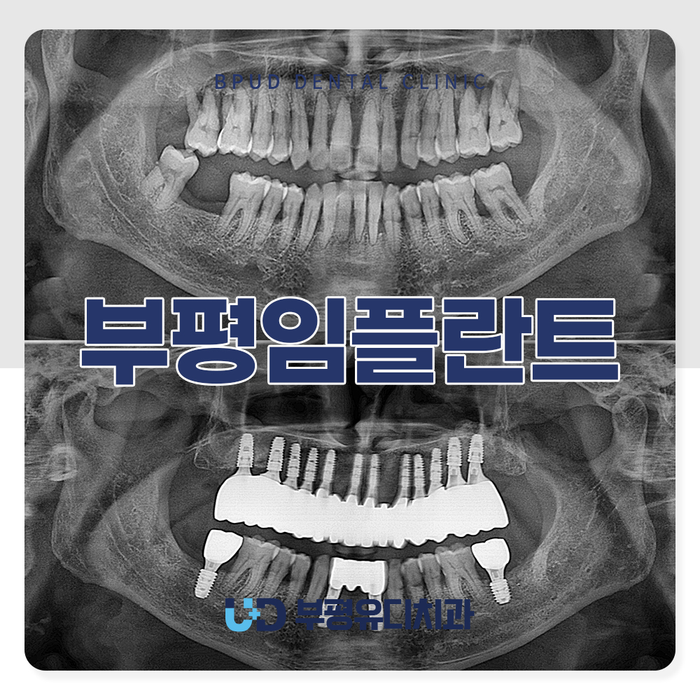 부평임플란트
