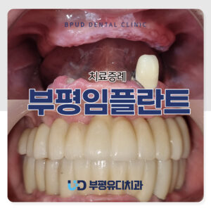 부평임플란트