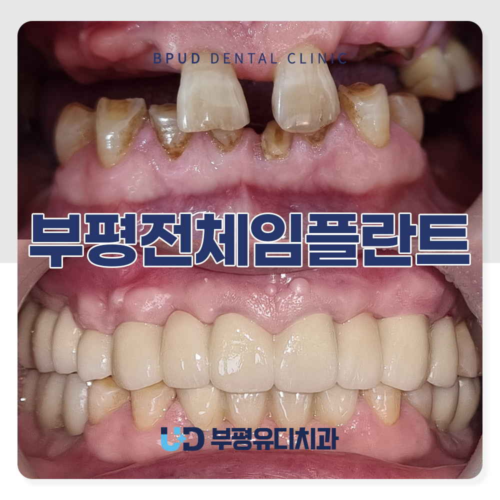 부평전체임플란트