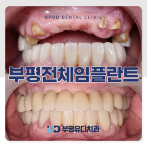 부평전체임플란트