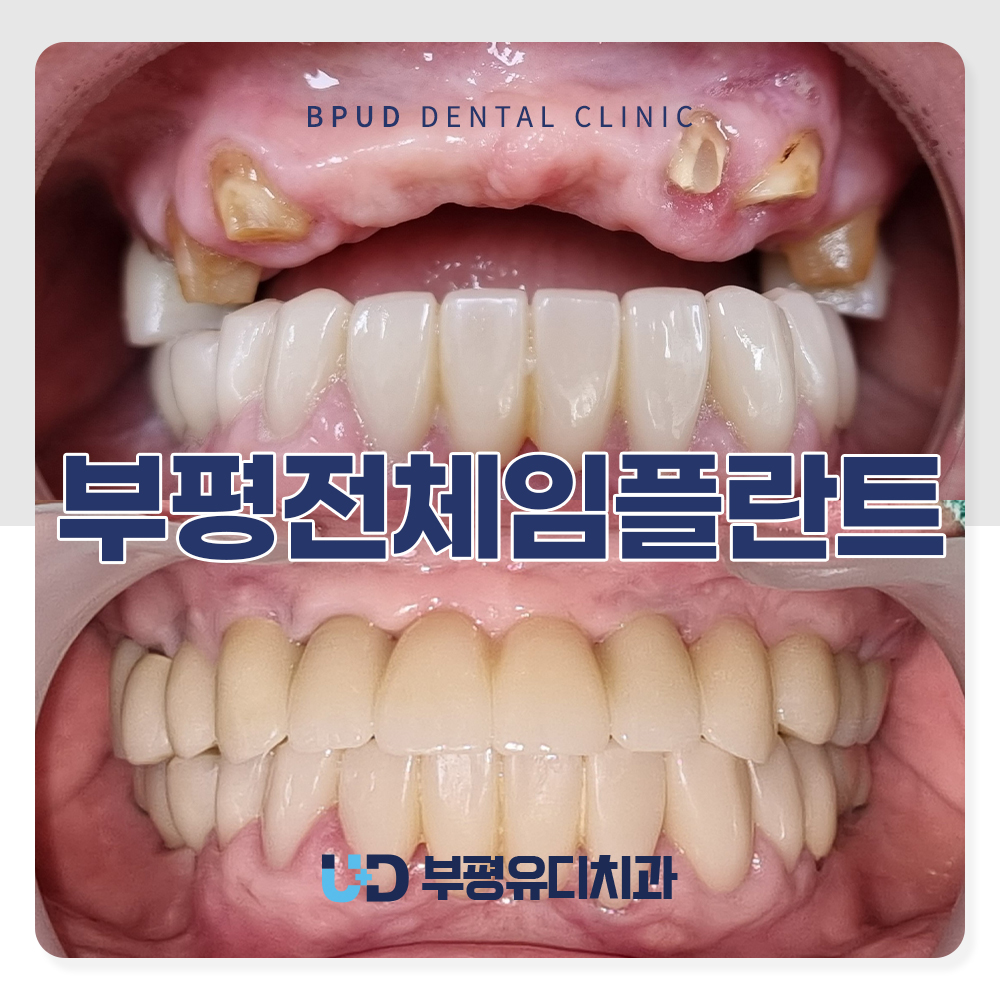 부평전체임플란트
