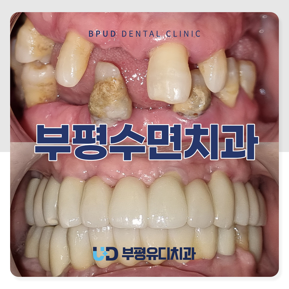 부평수면치과
